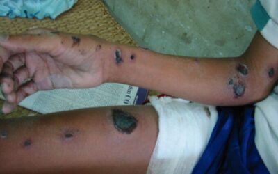 Disarming Disarmament: Withdrawals From the Mine Ban Treaty are a Negative Precedent
